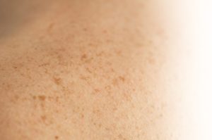 Skin on a man back with scattered moles 2025 03 06 11 40 48 utc