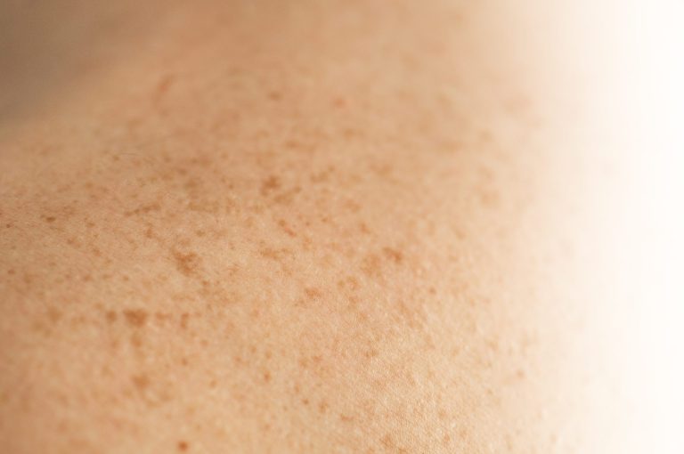 Skin on a man back with scattered moles 2025 03 06 11 40 48 utc