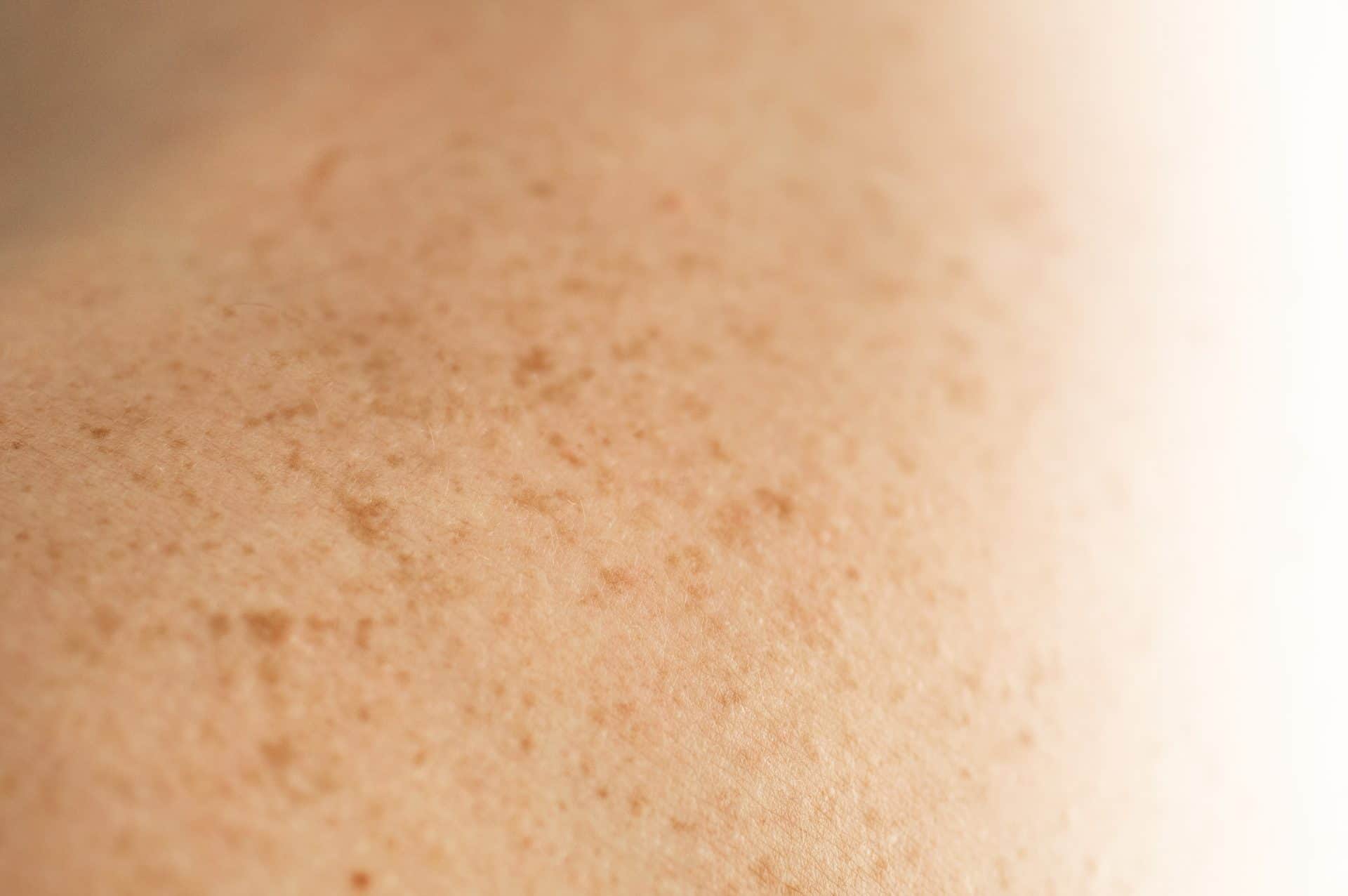 Skin on a man back with scattered moles 2025 03 06 11 40 48 utc